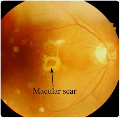 Study aims to understand role of immune cells in the development of macular scarring