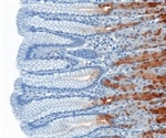 STR genotyping and p57 immunohistochemistry used to distinguish hydatidiform moles