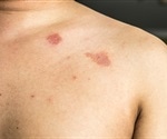 High school wrestlers have highest number of skin infections