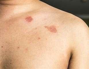 Tips to follow when you notice signs or symptoms of ringworm