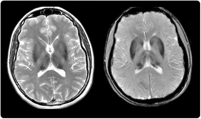 Aceruloplasminemia - Axial T2-weighted and axial GRE image demonstrates homogeneous iron deposition in caudate, putamen, globus pallidus and thalamus