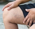 Minimally invasive procedure to treat varicose veins results in less swelling, bruising and minimal pain