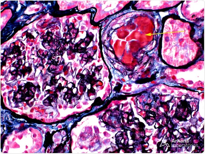 In this image of a combined silver-trichrome stain, the arrow points to the abnormal material within the arteriole lumen. This material was positive for IgM and showed kappa light chain restriction by immunofluorescence, supporting the diagnosis of paraprotein. Interestingly, this kidney biopsy was taken from an 81-year-old man with acute renal failure who had been diagnosed with Waldenström macroglobulinemia (his bone marrow biopsy showed involvement by lymphoplasmacytic lymphoma and he had a circulating IgM-kappa paraprotein). Image Credit: https://www.arkanalabs.com/
