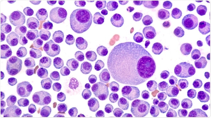 Bone marrow aspirate cytology of multiple myeloma, a type of bone marrow cancer of malignant plasma cells, associated with bone pain, bone fractures and anemia. Image Credit: David Litman / Shutterstock