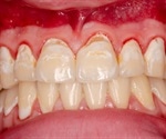 Bleeding Gums: When to be Concerned?