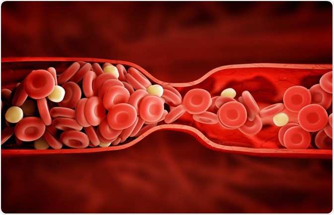 Factor V Leiden results in thrombophilia, a blood clotting condition that increases a person’s risk of developing abnormal blood clots. Image Credit: Adike / Shutterstock