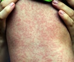 U.S. measles outbreak worst in 25 years
