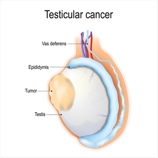 Testicular cancer. Tumor develops in the testicles. Image Credit: Designua / Shutterstock