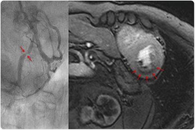Measuring blood flow in the myocardium with magnet resonance imaging (top). The dark area in the myocardium (arrows) shows a pronounced reduction of blood flow. The cardiac catheterization of the same patient (bottom) shows a clear constriction of the artery. Image Credit: Eike Nagel, Goethe University