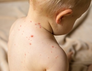 Study reveals how measles virus mutates and spreads in the human brain