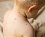 Researchers evaluate changes in measles vaccination rates before COVID-19 pandemic