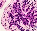 Targeted breast cancer therapy shows 'encouraging' results