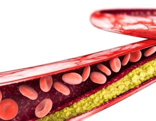 Arterial stiffness in adolescence may be a causal risk factor for insulin resistance and dyslipidemia