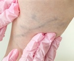 New AI algorithm may quickly, effectively diagnose deep vein thrombosis