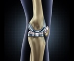 Pregabalin decreases pain after knee replacement surgery