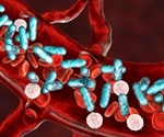 Sepsis deaths found to be much higher than previously estimated