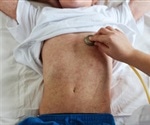 British boy dies from measles