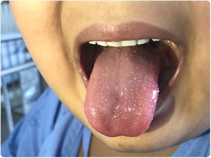 Strawberry tongue in case scarlet fever. (Strawberry tongue is the name given to a swollen, bumpy tongue. Most often, the enlarged tongue is very red, like a strawberry or raspberry.) Image Credit: Chalie Chulapornsiri / Shutterstock