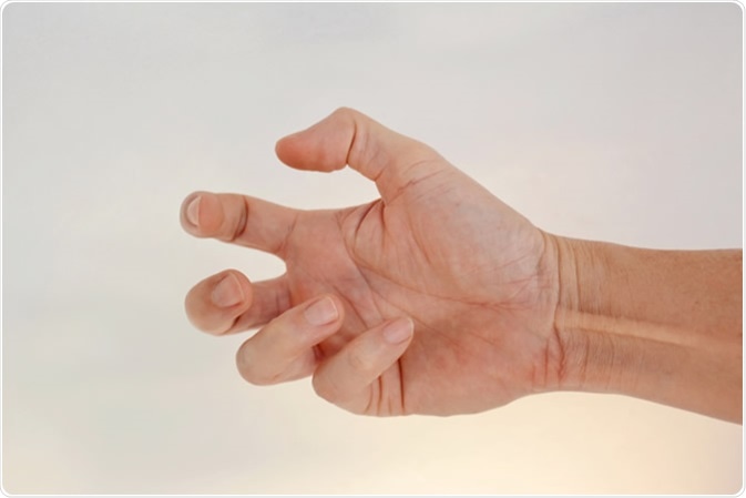 Hands of people with contractile dystonia - Image Credit: justvisarut / Shutterstock