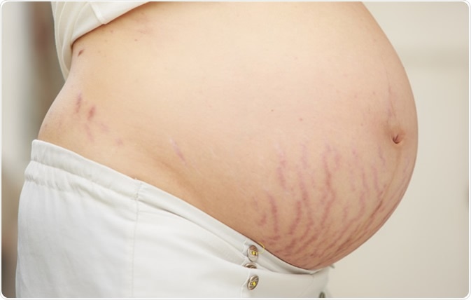 Closeup of a pregnant belly with stretch marks. Image Credit: baipooh / Shutterstock