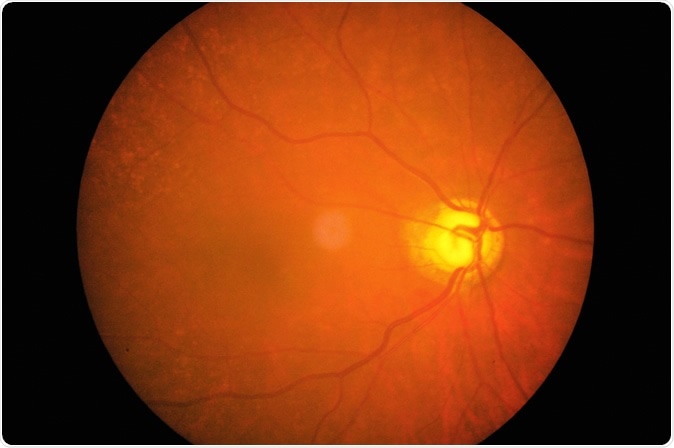 Retinal image of left eye in a 76 years old woman with glaucoma. Image Credit: Santibhavank P / Shutterstock