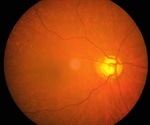 Long-term statin use linked to lower risk of glaucoma