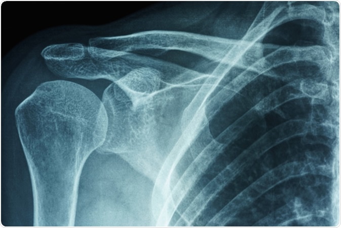 Lastra radioscopica del capsulitis congelato primario del collante o della spalla del paziente femminile asiatico. Credito di immagine: PK289/Shutterstock