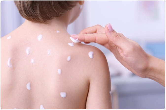 Woman applying cream onto skin of child ill with chickenpox, closeup - Image Credit: Africa Studio / Shutterstock