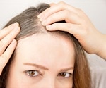 Hair loss could soon be a thing of the past, say researchers