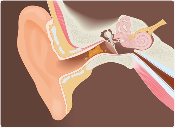 Section of the ear with earwax, diagram. Image Credit: struna / Shutterstock