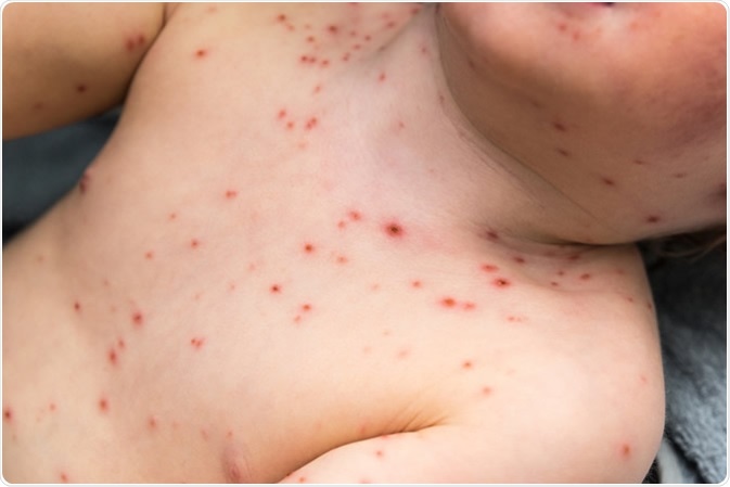 Young Child with Chickenpox - Image Credit: John-Kelly / Shutterstock
