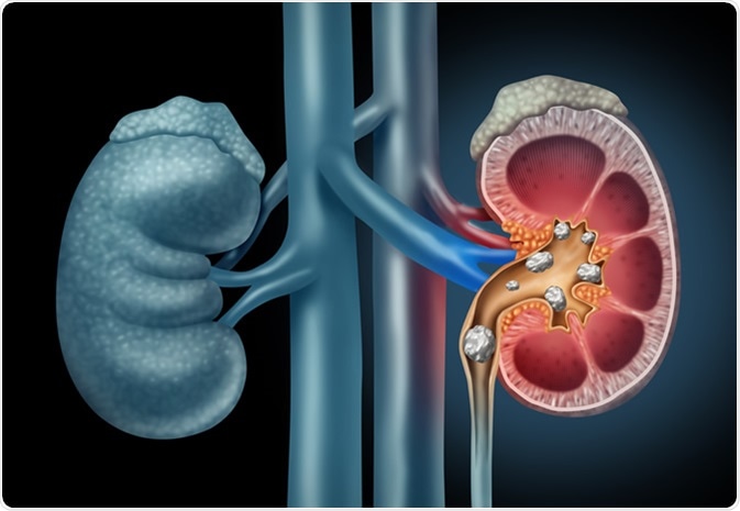 Human Kidney stones medical illustration. Image Credit: Lightspring / Shutterstock