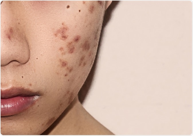 Close-up of acne on the skin. Image Credit: KirinIsHappy / Shutterstock