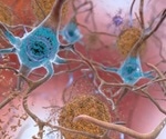 Altered protein and mutated clusters of genes in Alzheimer’s disease