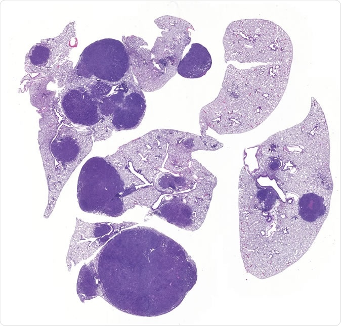 Image of lung cancer shows normal lung (light purple) and tumors (dark purple). Inactivation of SIK1 and SIK3 leads to tumor growth and inflammation, revealing for the first time that SIK kinases mediate key functions of LKB1 in preventing lung cancer. Click here for a high-resolution image. Credit: Salk Institute