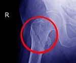 Experts explain what happens after hip fracture in older adults