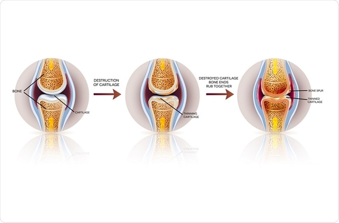 Diagram showing passage of time in osteoarthritis of the knee: healthy to diseased state.