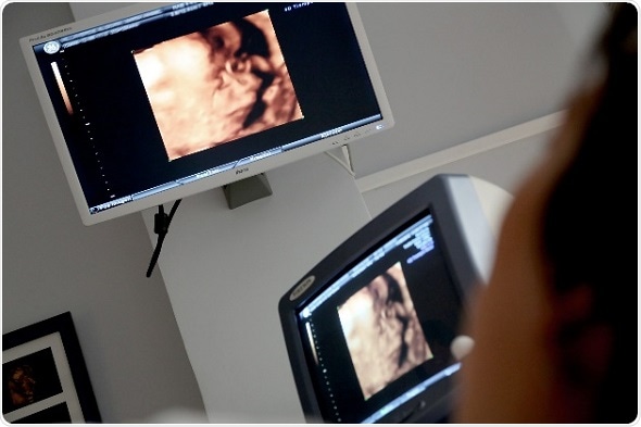 Antenatal renal pelvis dilatation increases risk of hospital admissions in early childhood