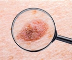 Origins of skin cancer melanoma