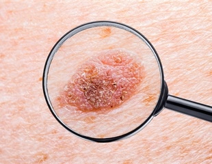 Melanoma could affect anyone regardless of skin color