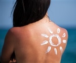 Higher-income individuals at increased risk of melanoma in Atlantic Canada, study finds