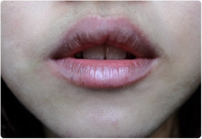 Dry lips and dark color lips caused by dehydration. Image Credit: FlyingFlokerr / Shutterstock
