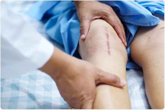 Patient scars from total knee joint replacement arthroplasty. Image Credit: Sasirin Pamai / Shutterstock