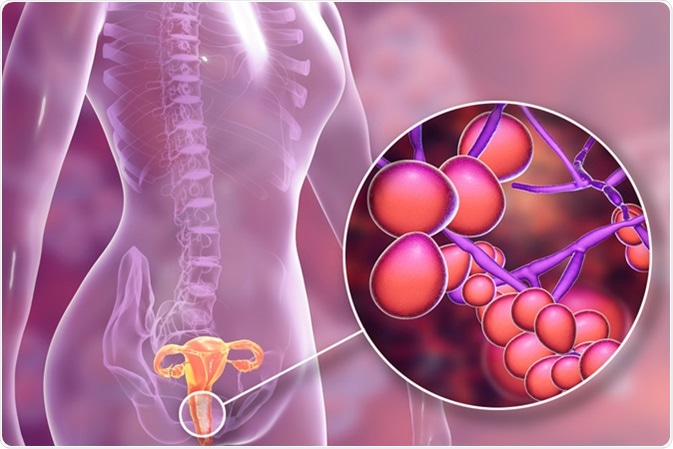 Vaginal thrush, female candidiasis, 3D illustration showing fungal vaginitis and close-up view of yeast fungi Candida - Illustration Credit: Kateryna Kon / Shutterstock
