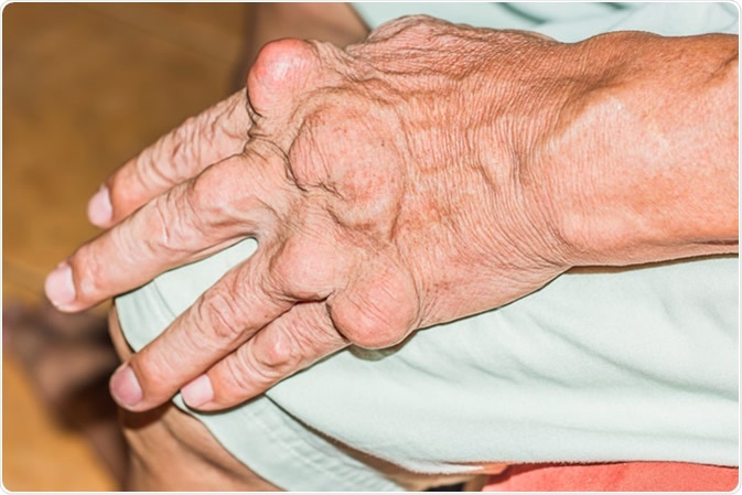 Case of severe gout. Image Credit: Adul10 / Shutterstock