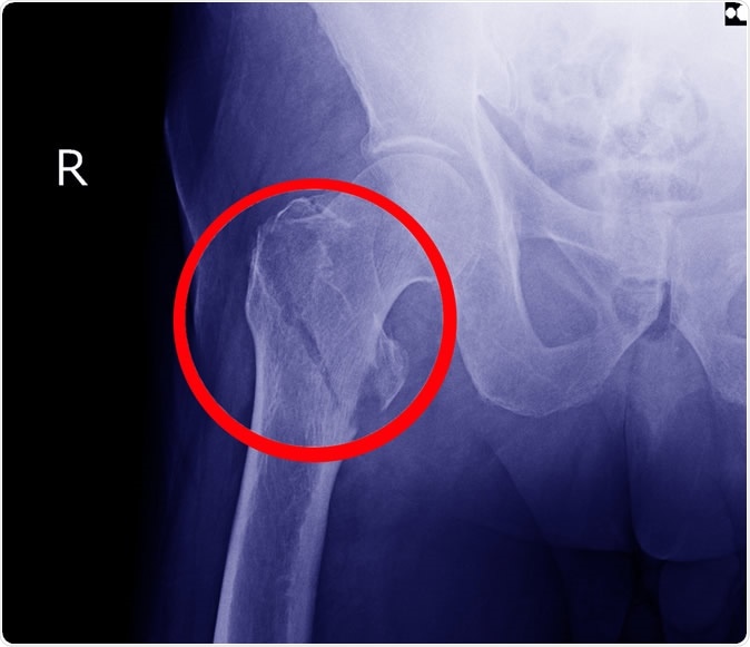 Hip fracture X-ray. Image Credit: Richman Photo / Shutterstock