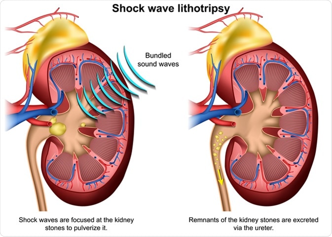 Shock wave lithotripsy 3D illustration. medicalstocks / Shutterstock