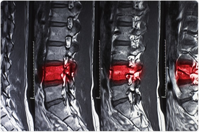 Magnetic resonance imaging of human show fracture and compress spine. Image Credit: SORANAT7 / Shutterstock
