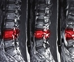 An injection of nanoparticles for spinal cord injuries