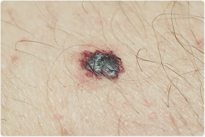 A melanoma. Image Credit: Krzysztof Winnik / Shutterstock